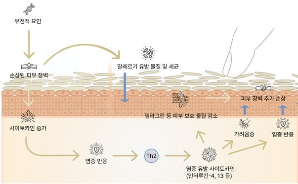 성인 아토피 발생 기작