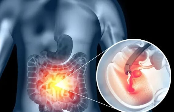 주기적으로 대장내기경 검사를 한 사람의 x레이 사진